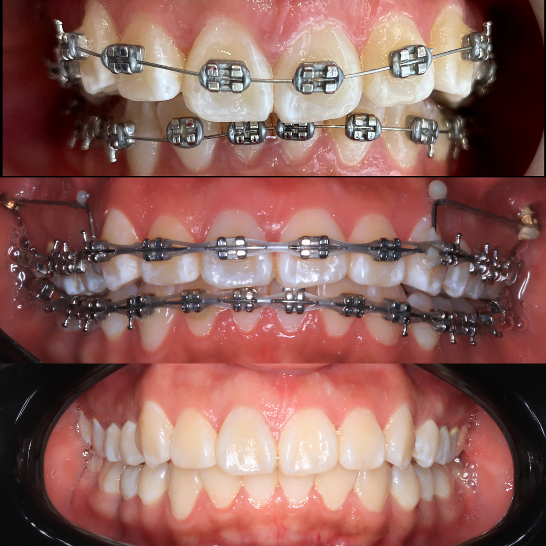 Caso de ortodoncia con brackets, antes y después