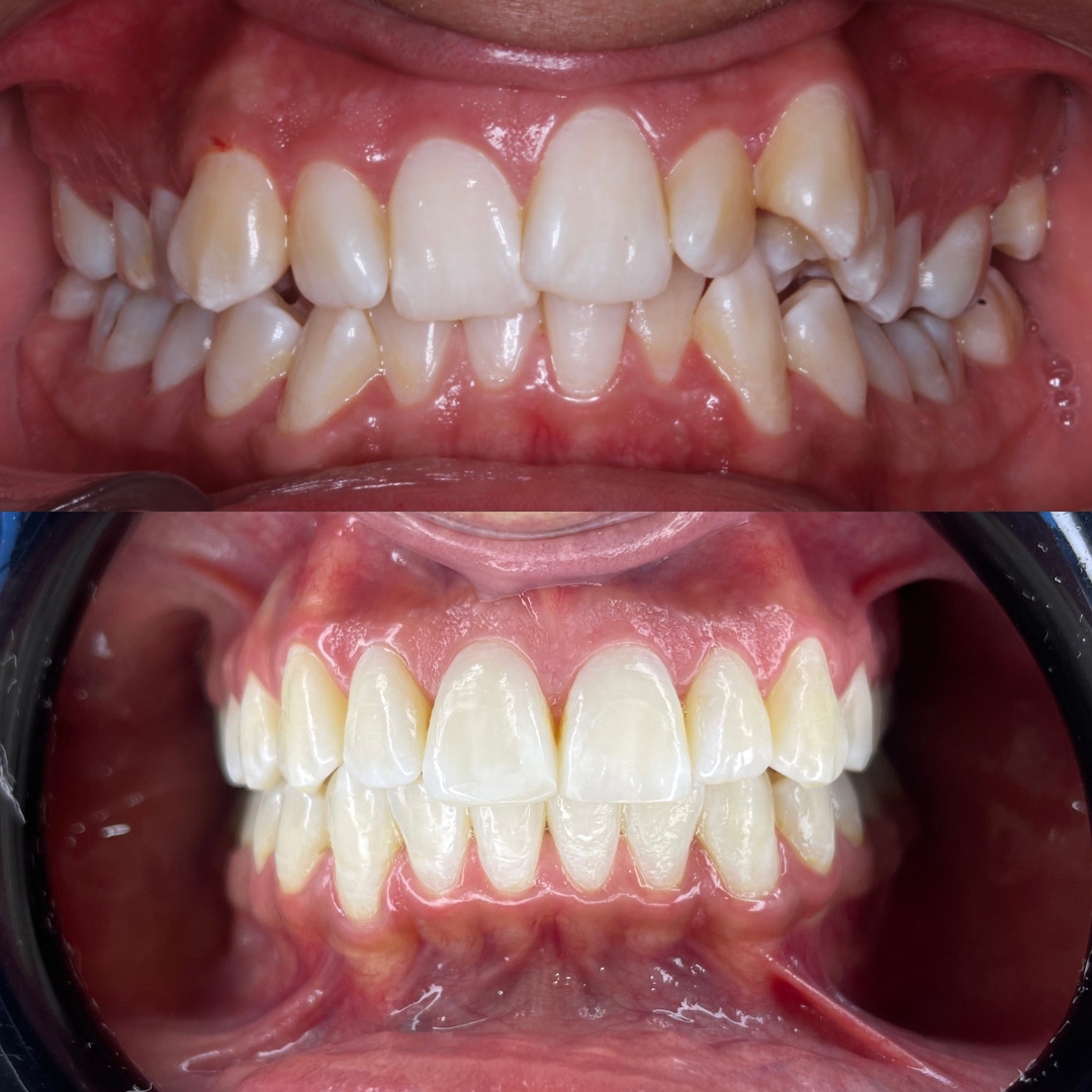 Caso de alineación dental, antes y después