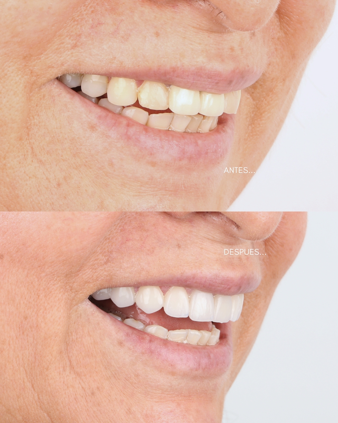 Caso de diseño de sonrisa, antes y después